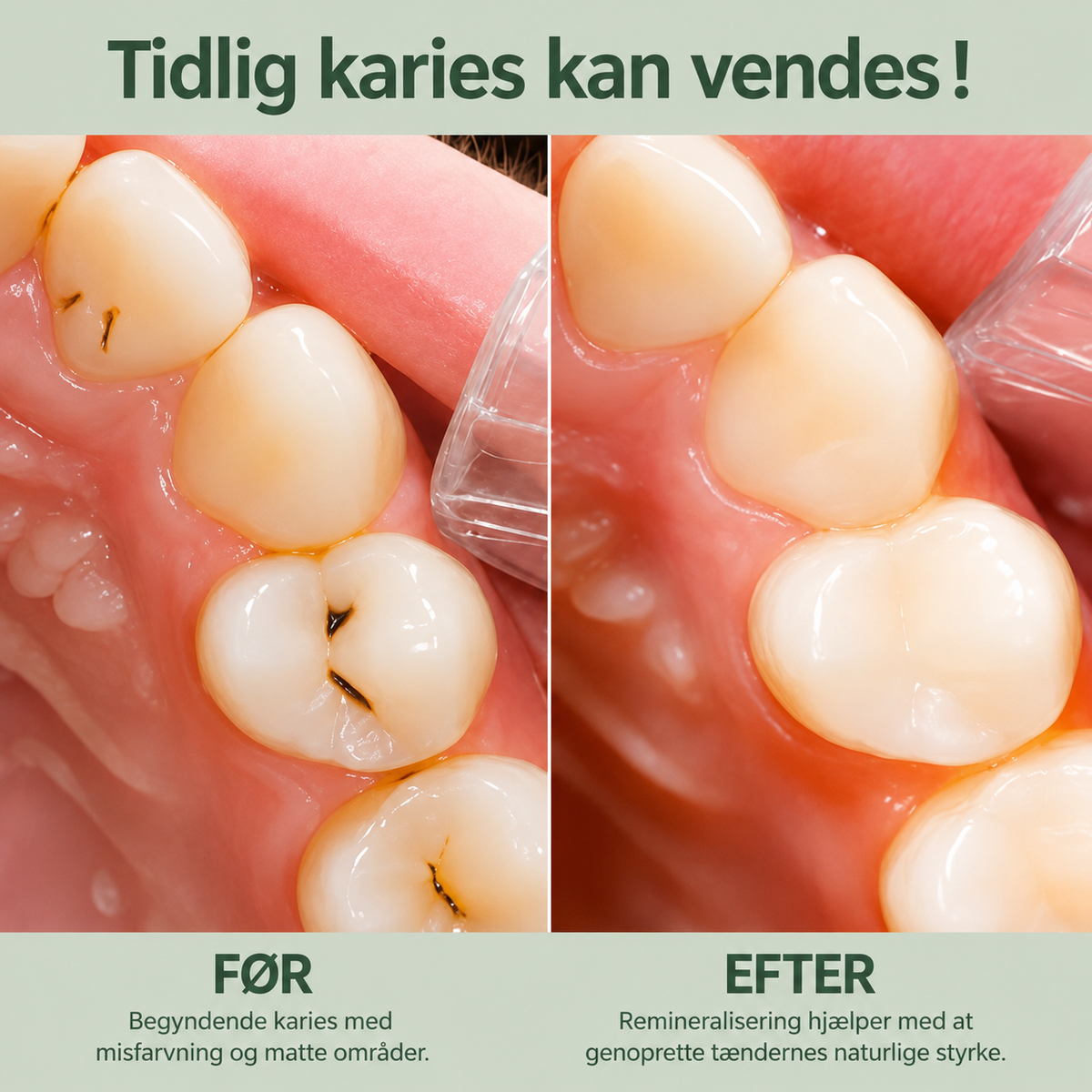 BirkTyg™ – Remineraliserende tyggegummi