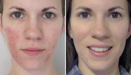 Velventh™ – Det beroligende serum mod rødme og irritation