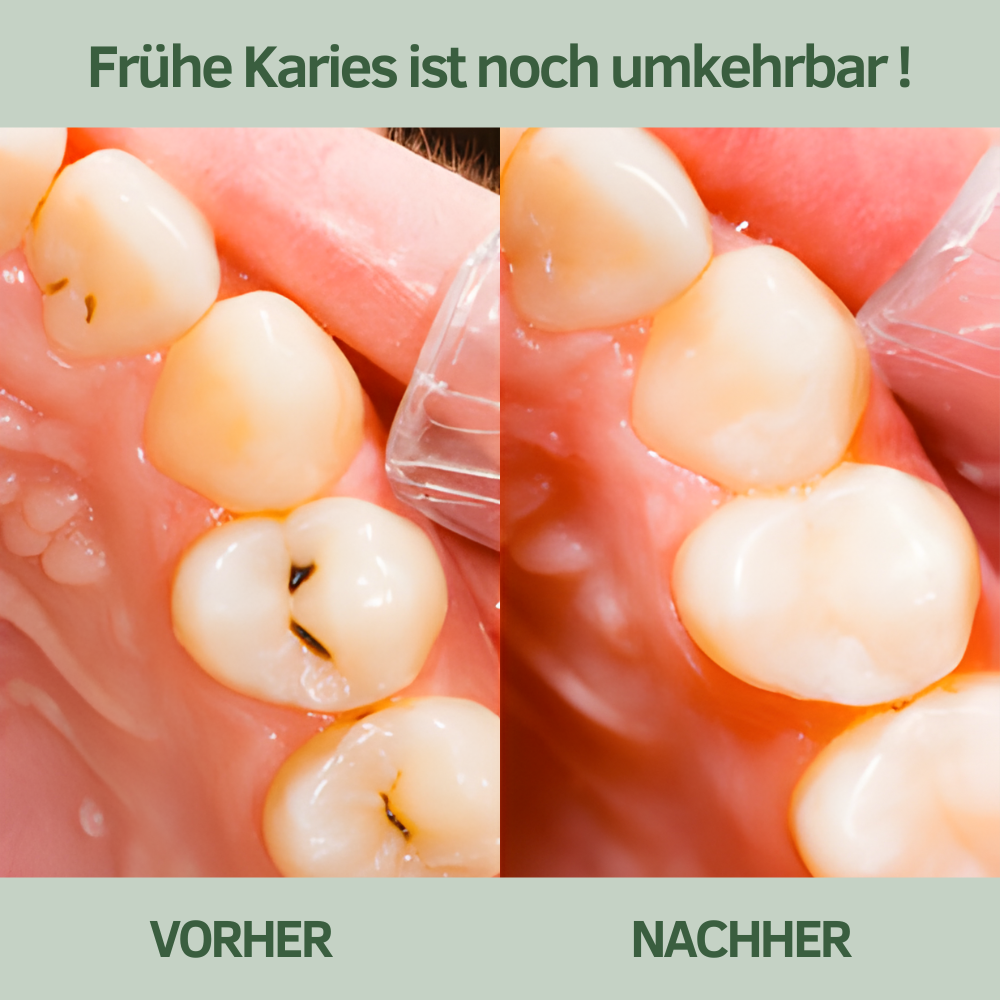 BirkTyg™ – Remineraliserende tyggegummi