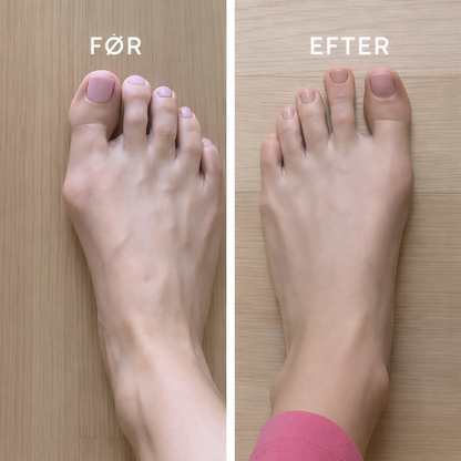 OrthoStep™ – Komfortabel korrektion og støtte til hallux valgus (1+1 GRATIS)