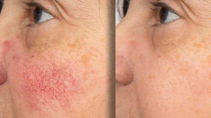 Velventh™ – Det beroligende serum mod rødme og irritation