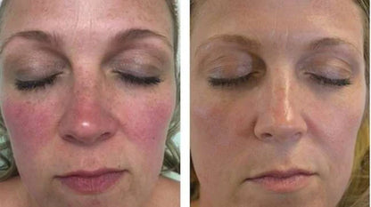 Velventh™ – Det beroligende serum mod rødme og irritation